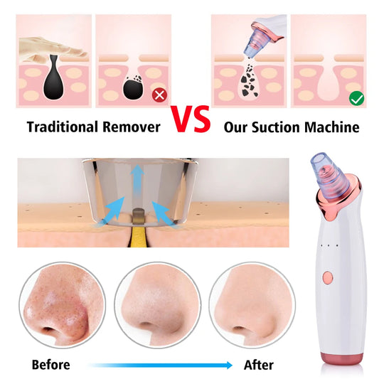 Electric Blackhead Vacuum - Professional Pore Cleaner & Acne Remover